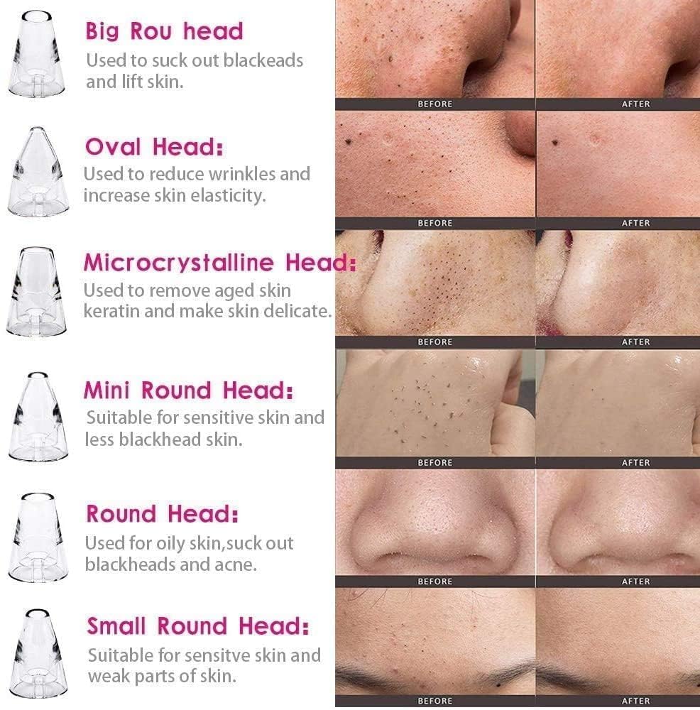 6-in-1 Multi-Function Blackhead Remover Vacuum | Electric Pore Cleaner & Dermasuction Tool | USB Rechargeable Facial Pore Extractor for All Skin Types