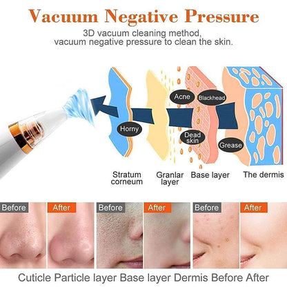 6-in-1 Multi-Function Blackhead Remover Vacuum | Electric Pore Cleaner & Dermasuction Tool | USB Rechargeable Facial Pore Extractor for All Skin Types