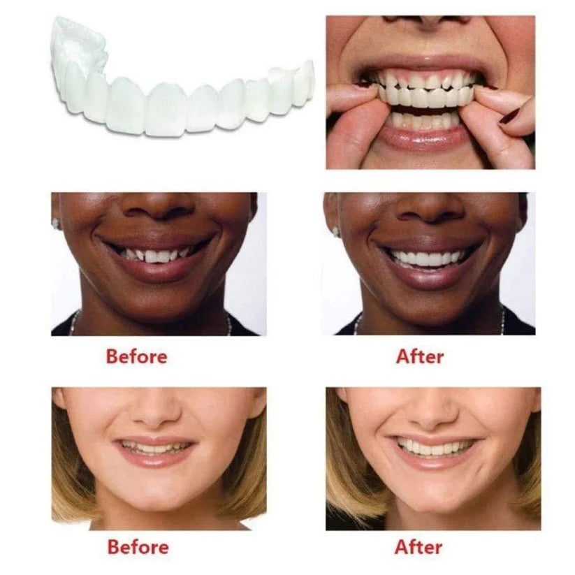 Instant Snap-On Smile Clip-On Veneers | Temporary Teeth Braces Cover for Perfect White Smile